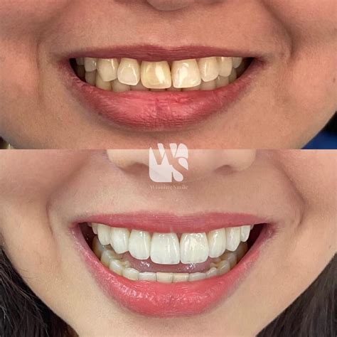 Veneers Price in the Philippines in 2024: All you need .